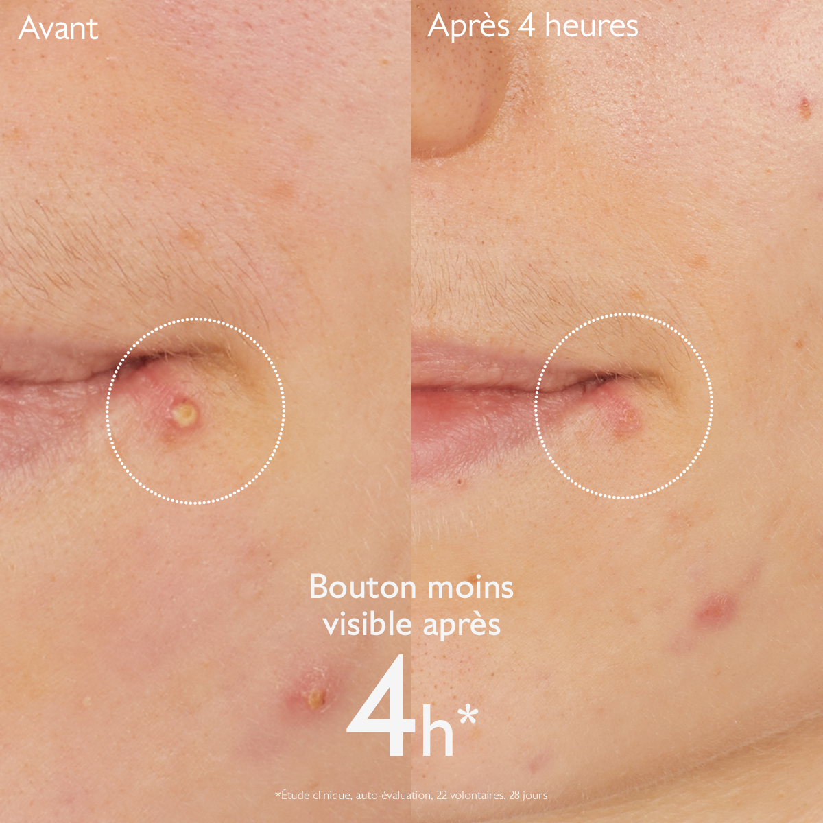 Caudalie Vinopure - Stop boutons salicylique – Image 5